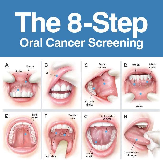 How can I tell if I have Oral Cancer?