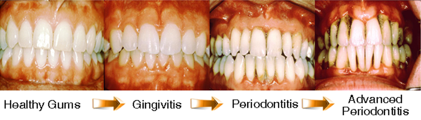 Progression-of-gum-disease