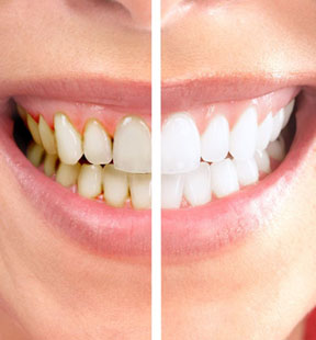teeth-whitening-thm